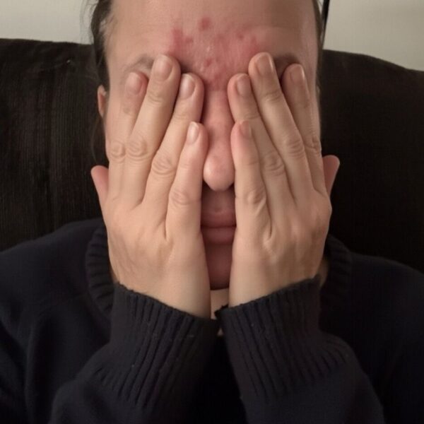 WHAT IS ROSACEA?