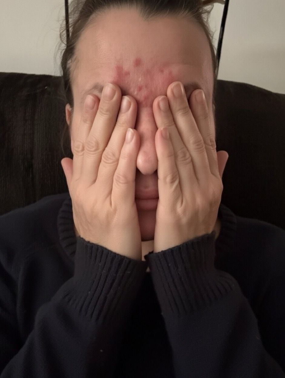 WHAT IS ROSACEA?